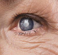 Why Cataracts Form and How We Treat Them